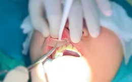 Nhập viện nguy cấp vì sụn mũi nhân tạo đâm vào vùng lợi