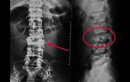 Cần Thơ: Cứu bệnh nhân leo dừa té gãy xương cột sống
