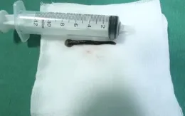 Lấy con vắt dài 8cm sống trong lòng khí quản người đàn ông suốt 2 tuần