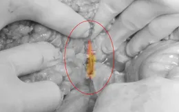 Uống cốc bia có tăm xỉa răng, một người phải nhập viện vì thủng tá tràng