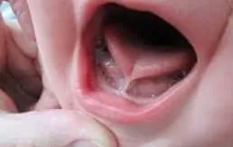 Con chậm nói, nói ngọng... - coi chừng mắc phải dị tật này!