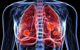 Điều trị ung thư phổi bằng phương pháp ghép phân tử hóa trị