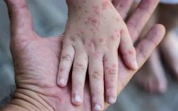 WHO công bố Sri Lanka và Maldives đã thanh toán được bệnh sởi và rubella