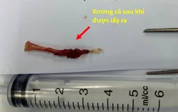 Vừa ăn vừa trả lời điện thoại, mảnh xương cá găm vào cổ họng suốt 3 tháng