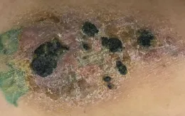 Những lưu ý khi chăm sóc hình xăm trên da