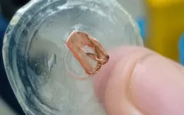 Lất dị vật bám chặt vào họng bé gái 3 tuổi suốt 22 ngày
