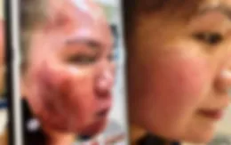 Cầu cứu bác sĩ vì làn da bỏng, phù nề sau khi bôi thuốc trị trứng cá mua trên mạng