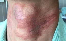 Cẩn trọng kiến ba khoang gây tổn thương da