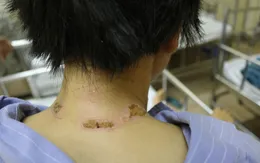 Thương tích hãi hùng trên cơ thể người phụ nữ suýt mất mạng vì sét đánh