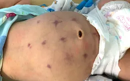 Bé sơ sinh 25 ngày tuổi bị cấu tím bụng để "chữa"... đầy bụng