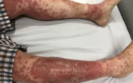Tự điều trị vảy nến, người đàn ông Hải Phòng gặp phải biến chứng