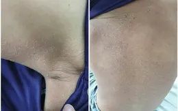 Bé trai 5 tuổi da bong vảy do hội chứng 4S