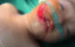 Ngã vào mảnh bát vỡ, bé 15 tháng bị cắt từ môi đến má
