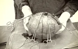 Người phụ nữ mang khối u xơ gần... 10kg trong ổ bụng