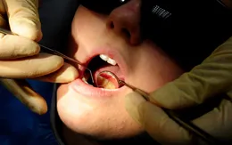 Lười đánh răng, coi chừng nguy cơ ung thư miệng và dạ dày