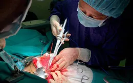 Sự nguy hiểm của ung thư gan thứ phát