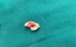 Đi nhổ răng sâu, bé gái bị tắc đường thở sau khi... răng "biến mất"?