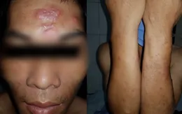 Phát hiện một ca mắc bệnh phong ở Lạng Sơn