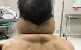 "Biến" thành... người khổng lồ sau nhiều năm nghiện rượu