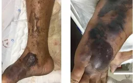 Cảnh giác với loài "vi khuẩn ăn thịt người" đến từ biển