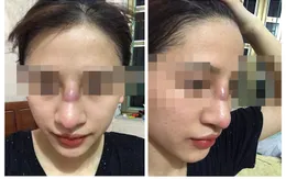 Cô gái trẻ suýt thủng mũi sau khi nâng mũi tại spa