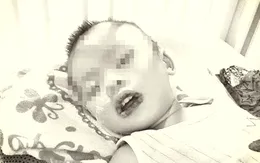 Uống nhầm nước tẩy bồn cầu, bé 21 tháng loét miệng, dạ dày