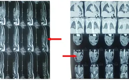 12 tiếng phẫu thuật cho bé trai bị u sau phúc mạc phức tạp
