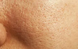 Phiền toái vì lỗ chân lông to phải làm sao?
