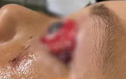 Bé trai bị chấn thương mắt nghiêm trọng khi đi xe đạp