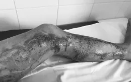 Cứu hai vợ chồng bị sét đánh khi đang làm đồng