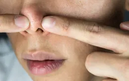 Nhiễm trùng nghiêm trọng từ thói quen nặn mụn trên mũi