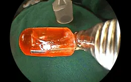 Bé 10 tháng tuổi nguy kịch do nuốt đầu đèn điện thoại nhựa vào phổi