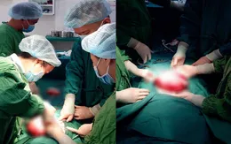Rối loạn kinh nguyệt, rong kinh kéo dài vì u xơ nặng 3kg
