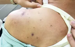 Bị ong vò vẽ đốt hơn 40 nốt, người đàn ông nguy kịch