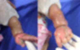 Cảnh báo tai nạn bỏng ở trẻ nhỏ