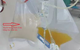 Một phụ nữ huyết thanh trắng đục như sữa do viêm tụy cấp