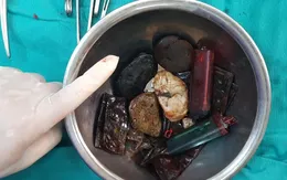 Bác sĩ lấy bật lửa, sỏi, túi nilon từ... dạ dày bệnh nhân
