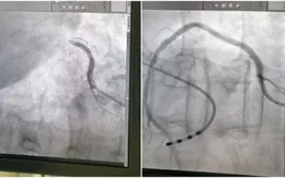 Cứu bệnh nhân nhồi máu cơ tim cấp biến chứng sốc tim, ngừng tuần hoàn