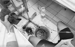 Cứu người bệnh ho ra máu sét đánh nguy kịch tính mạng