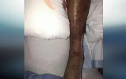 Mỹ: 5 người nhiễm vi khuẩn ăn thịt người sau khi hoạt động dưới nước