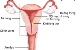 Quá sản nội mạc tử cung tiến triển thành ung thư vì không điều trị sớm