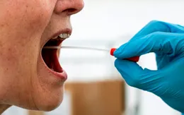 Phát hiện thêm triệu chứng lạ ở lưỡi của bệnh nhân COVID-19