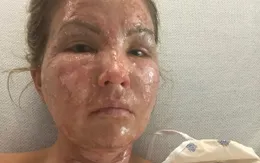 Dùng nước rửa tay khô không rõ nguồn gốc, một phụ nữ Mỹ bị bỏng nặng