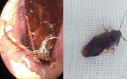 Gắp con gián còn sống trong tai bệnh nhân