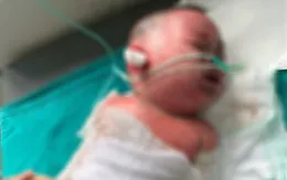Nỗ lực cứu sống bé 9 tháng tuổi bị bỏng 45% diện tích cơ thể