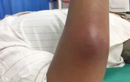 Mụn viêm gây áp xe - Tình trạng da nguy hiểm chớ coi thường