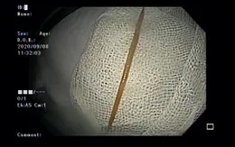 Đi khám vì đau bụng, cụ ông phát hiện tăm dài 5cm đâm vào tá tràng