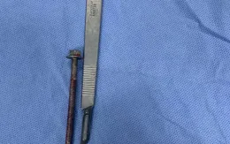Phẫu thuật lấy dị vật dài 6cm khỏi cơ quan sinh dục người đàn ông.