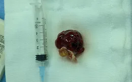 Cứu sống bệnh nhân vừa bị u nhầy nhĩ trái kèm hở nặng van động mạch chủ