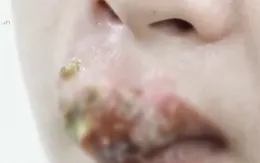 Phẫu thuật làm đẹp đón Tết, nhiều chị em chịu hậu quả nặng nề